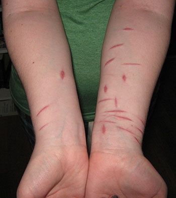 SELF-HARM SELF-HARM