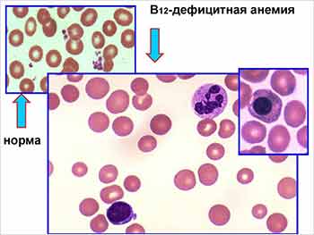 Клетки крови в норме и при пернициозной анемии