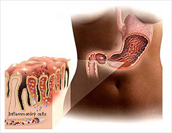 Локализация Helicobacter pylori в желудке человека Локализация Helicobacter pylori в желудке человека