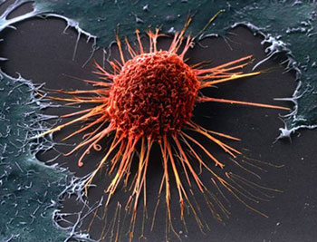 Изображение раковой клетки злокачественной опухоли